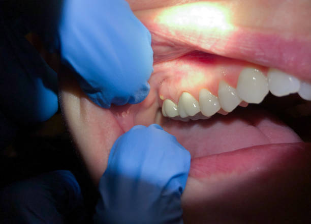 Best Emergency Tooth Extraction in Salem, OR
